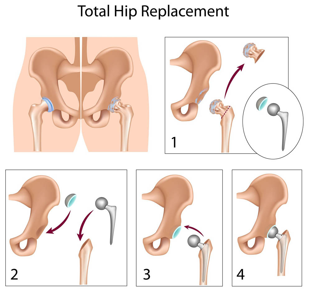 Total hip replacement surgery