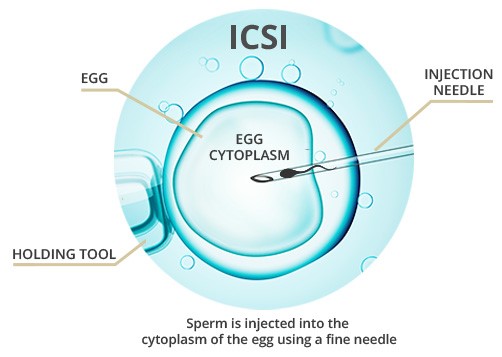 ICSI Fertility Treatment