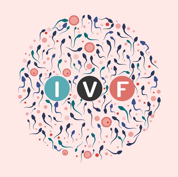 IVF nach Tubenligatur