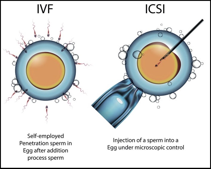 difference between ICSI and IVF