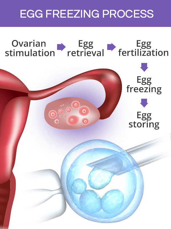 proceso de congelación de óvulos