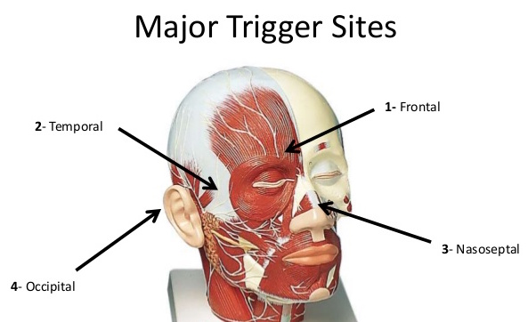 migraine trigger points