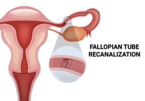 Fallopian Tube Recanalization