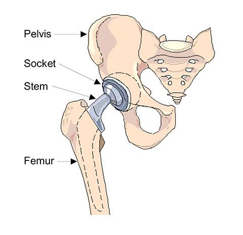 Arthroplastie de la hanche
