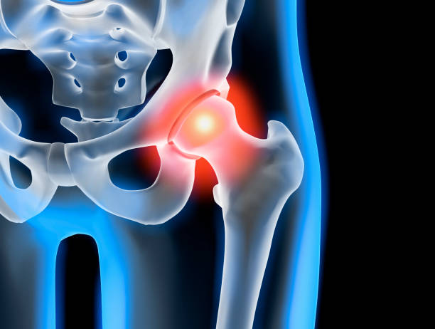 How Much Does a Hip Replacement Cost Privately?