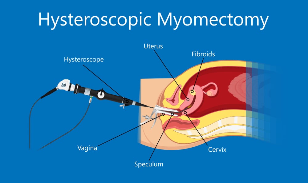 Miomectomía histeroscópica