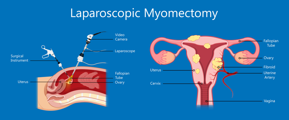 Miomectomía Laparoscópica