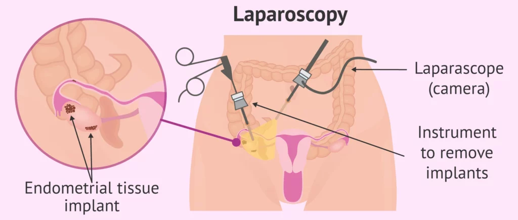 Eliminación laparoscópica de endometriosis