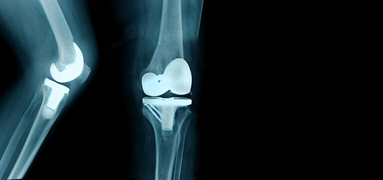 Хирургия с минимальной инвазивной коленной заменой