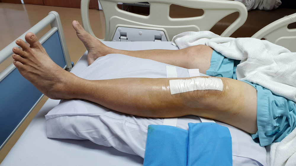 Minimally Invasive Knee Replacement Surgery procedure