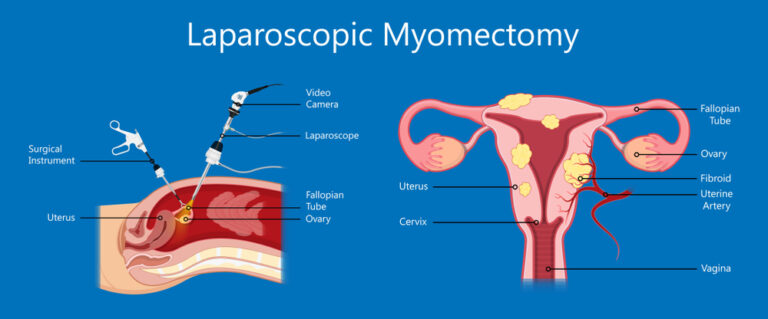 Myomectomy