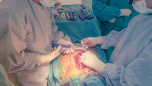 Revisionsbild der Wirbelsäulenchirurgie