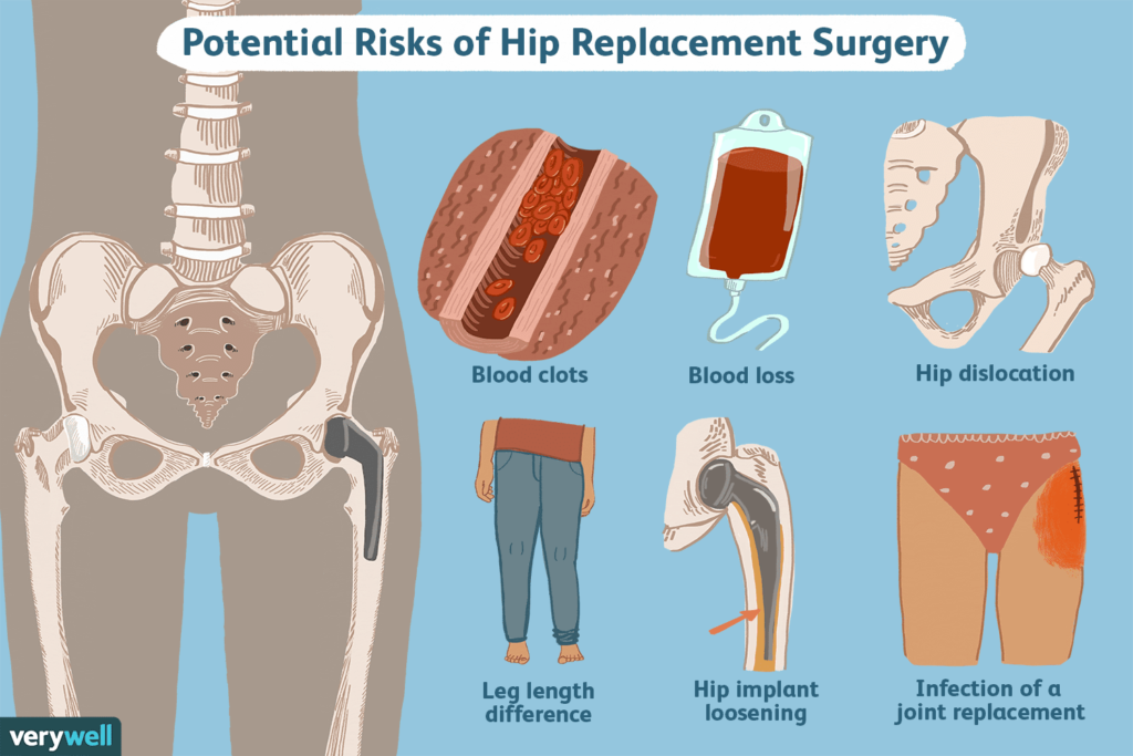 Quels sont les risques du remplacement de la hanche