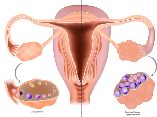 IVF ovarian stimulation