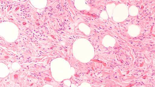 Lipoma de células fusiformes