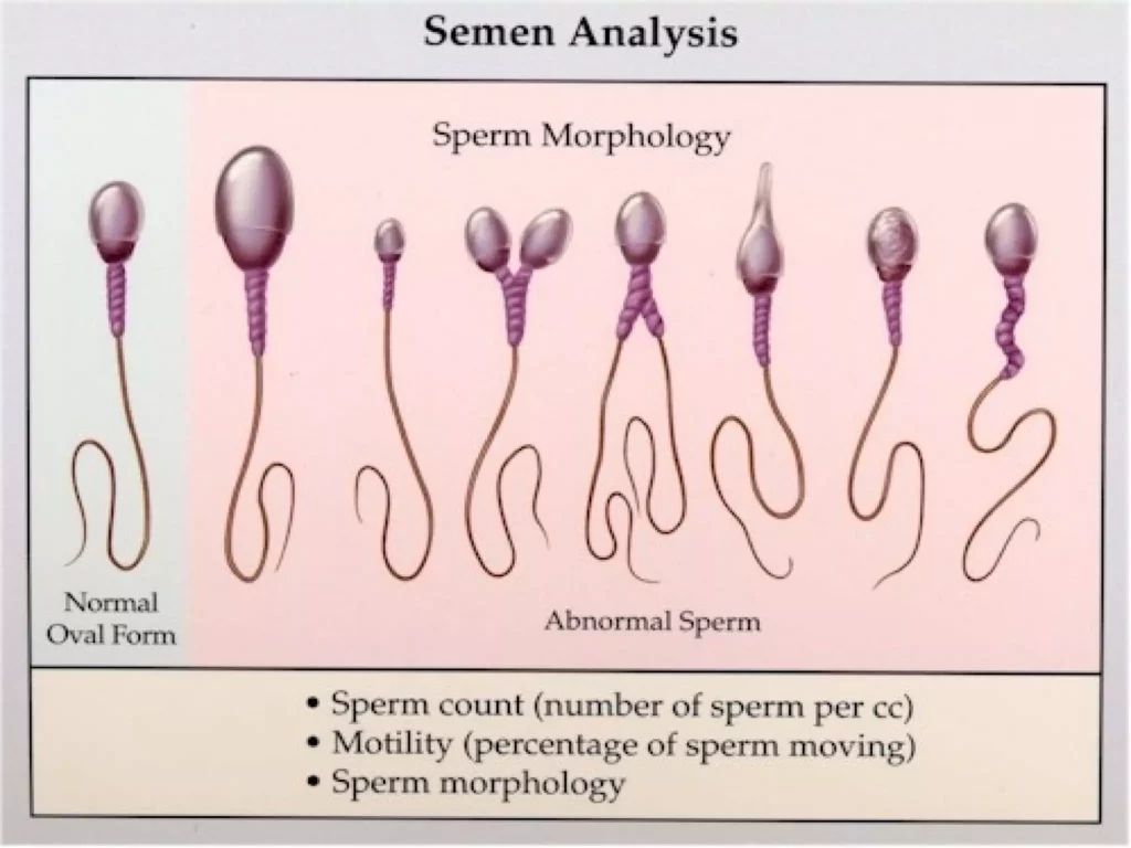 How is male infertility evaluated?