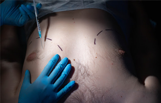 Procédure de chirurgie d'élimination de la graisse de la poitrine chez l'homme
