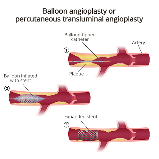 Angioplastia transluminal percutánea