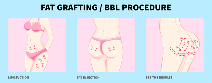 BBL and BMI: Is There a Weight Limit for the Procedure - skinny bbl