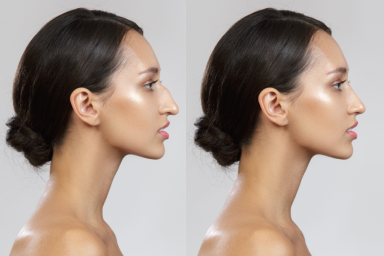 Finding the Right Rhinoplasty Surgeon: Key Factors to Consider