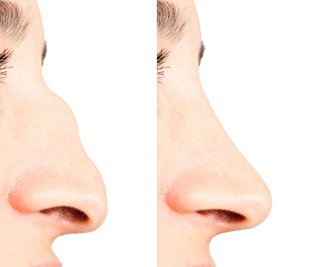 Finding the Right Rhinoplasty Surgeon- Key Factors to Consider