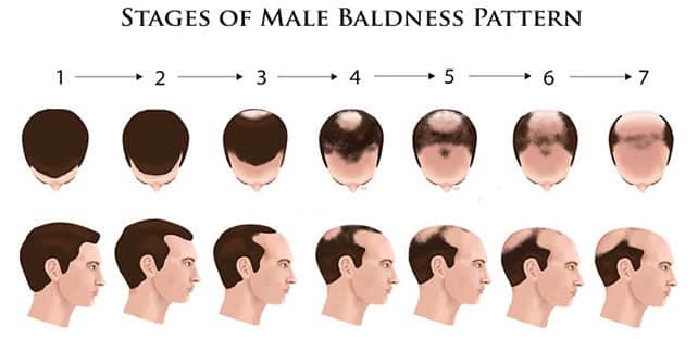 Perte de cheveux chez les hommes : comprendre la calvitie masculine