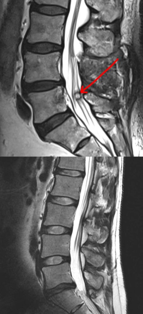 Synovial Cyst of the Spine diagnosis