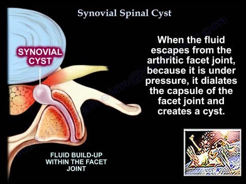 Bild einer Synovialzyste der Wirbelsäule