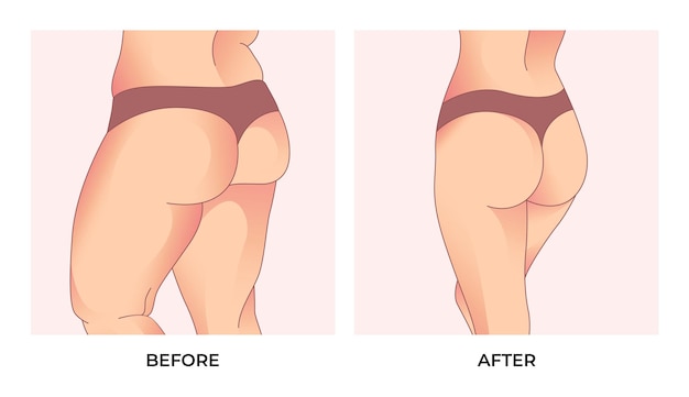 Brazilian Butt Lift Recovery Tips and Timeline