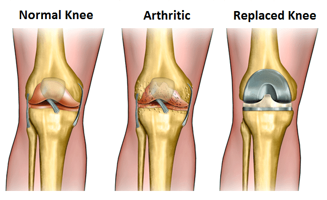 Choosing the Right Knee Replacement Surgeon-Important Factors to Consider- knee replacement surgery