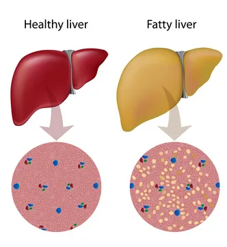 Fatty Liver and PCOS: Understanding the Connection