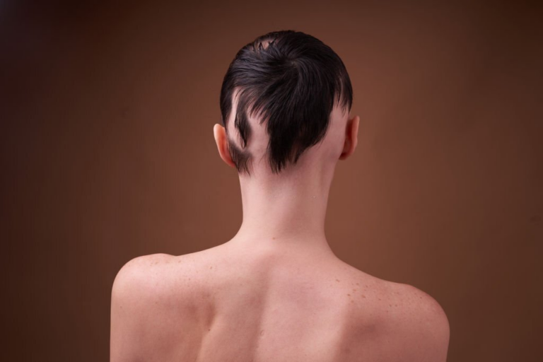 Caída del cabello y trastornos de la tiroides Comprensión de las conexiones