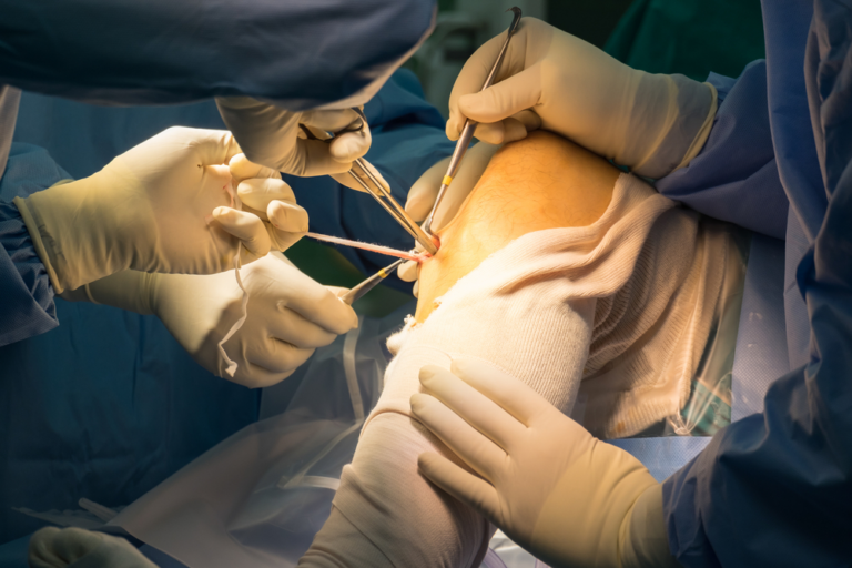 Prévenir les blessures du LCA : comment la chirurgie de reconstruction du LCA peut aider