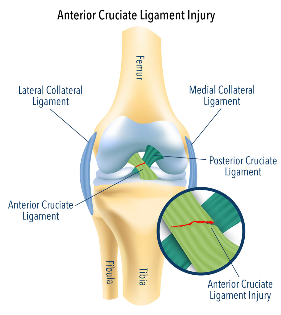 ACL Reconstruction Surgery- Benefits and Expected Outcomes 

