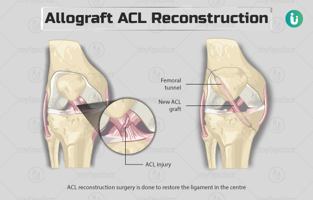 ACL Reconstruction vs. Conservative Treatment: Which Is Best for You?