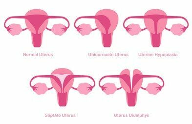 Congenital Uterine Anomalies
