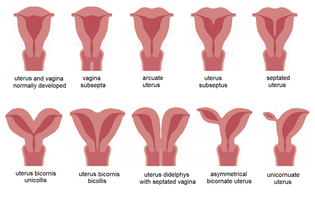 Types of Congenital Uterine Anomalies