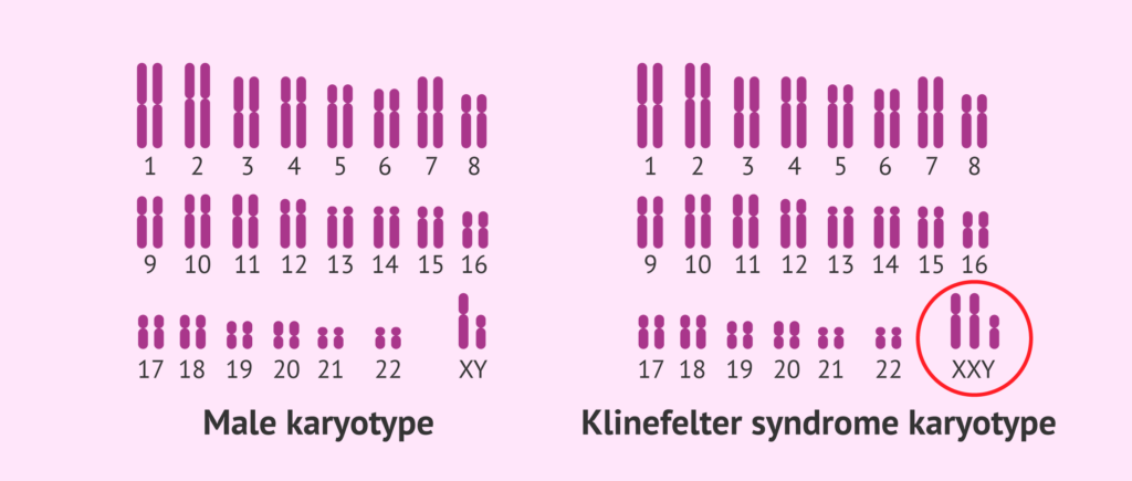 Decoding Klinefelter Syndrome and Male Infertility