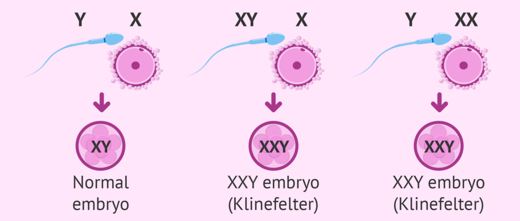 Decoding Klinefelter Syndrome and Male Infertility- karyotype cause
