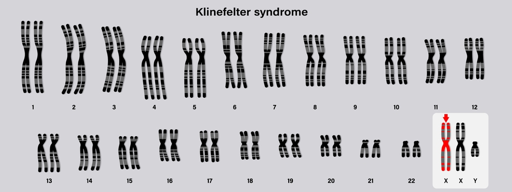 Decoding Klinefelter Syndrome and Male Infertility