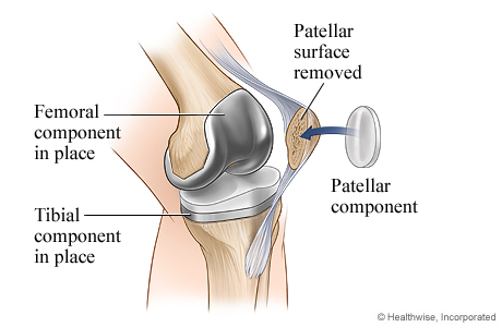 Diferentes tipos de implantes de rodilla para cirugía de reemplazo: componentes
