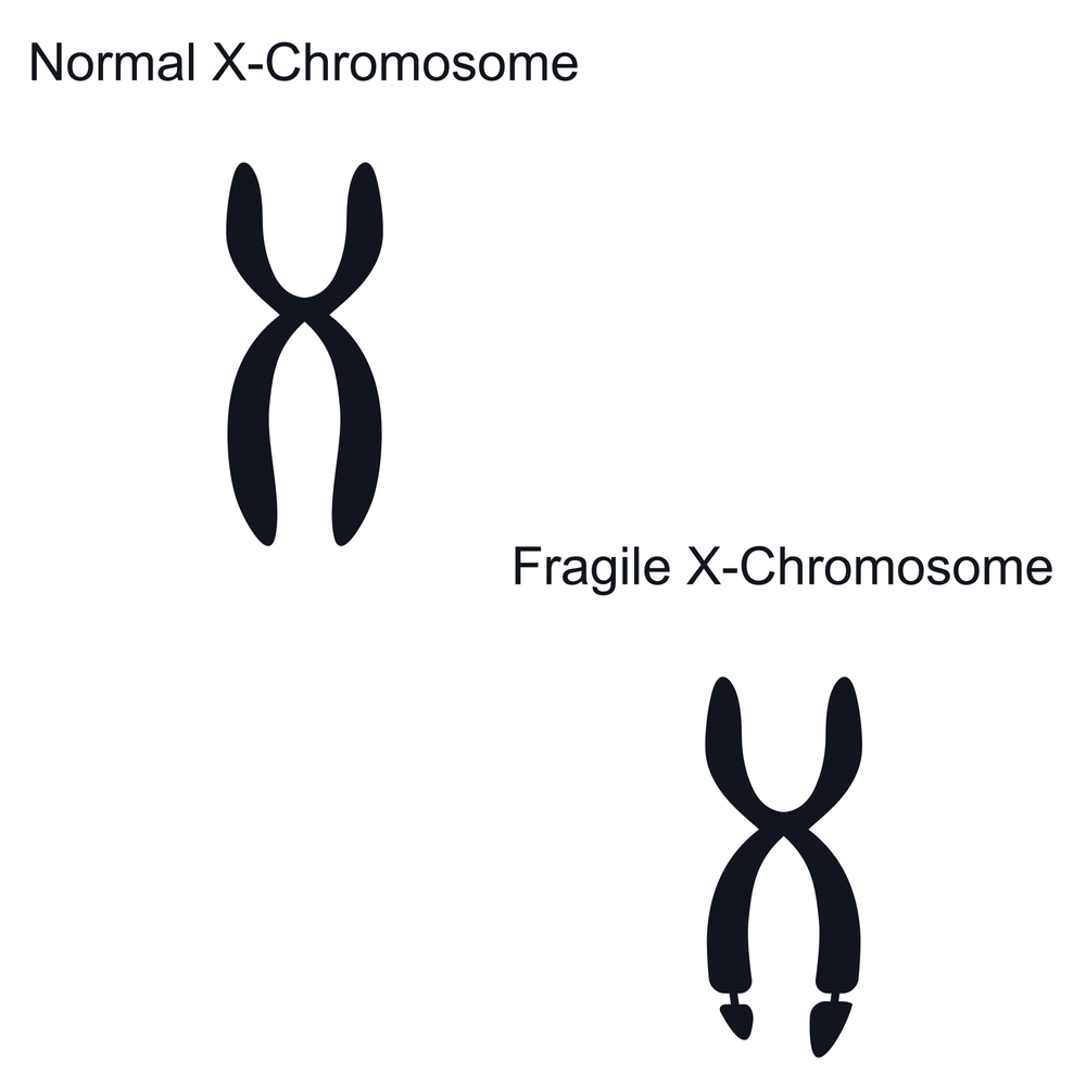 Fragile X Syndrome and Fertility: Breaking Barriers to Parenthood - cause