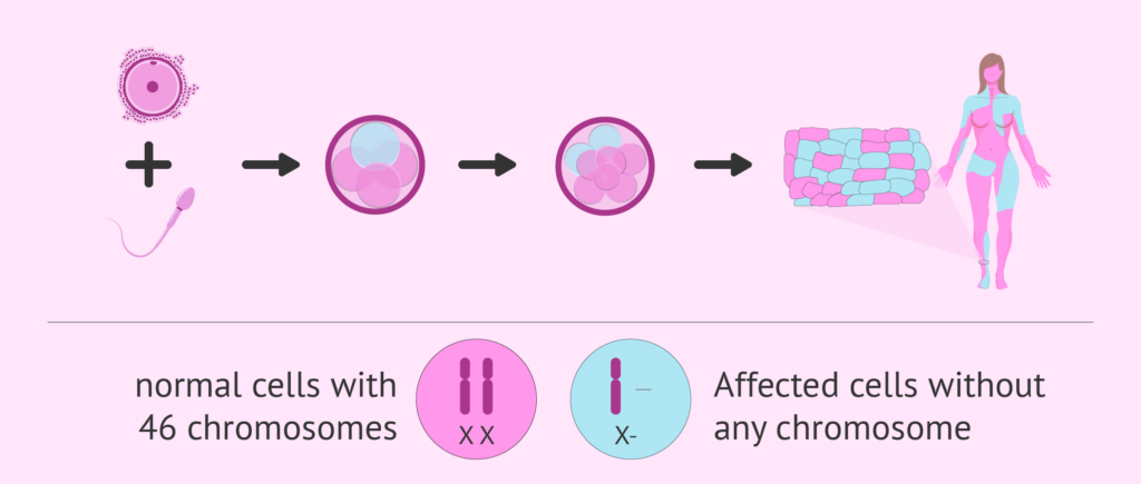 De XX a XY: las complejidades del síndrome de Turner y la infertilidad femenina