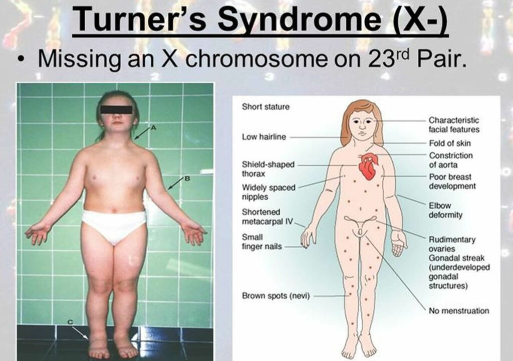 De XX a XY: Las complejidades del síndrome de Turner y la infertilidad femenina: síntomas