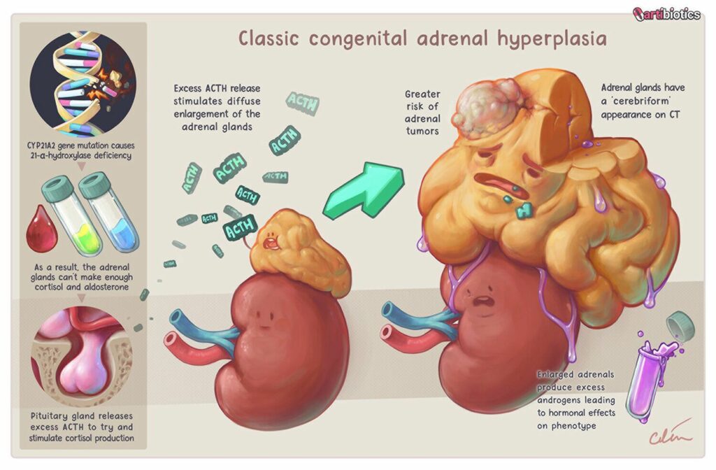 Hormonal Hitch: How Congenital Adrenal Hyperplasia Affects Fertility
