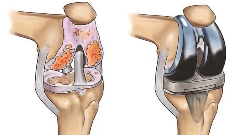 Knee Replacement vs Knee Arthroscopy: Which is Right for You?