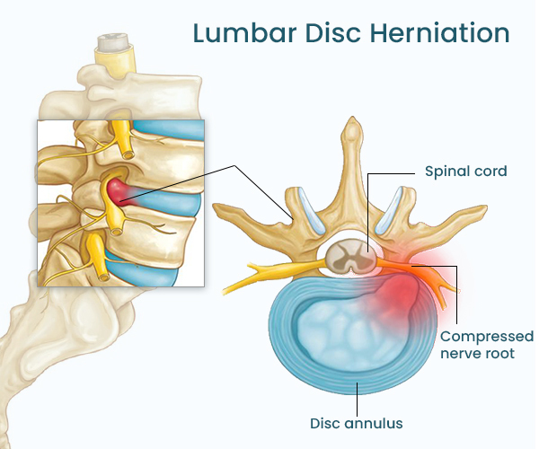 hernia de disco lumbar