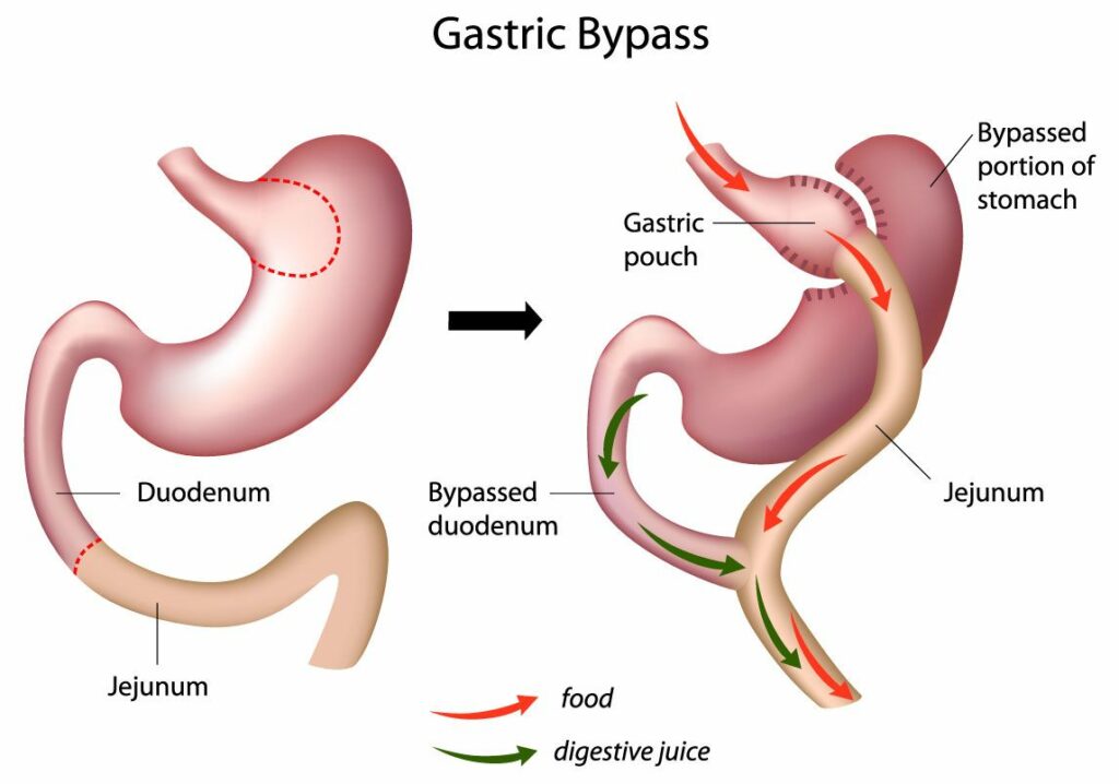 Bariatric Surgery – gastric bypass
