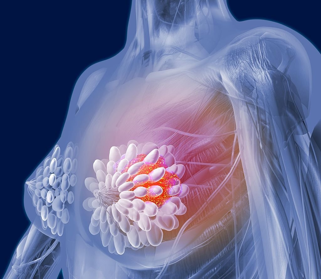 Breast Cancer Surgery Options: Lumpectomy vs. Mastectomy