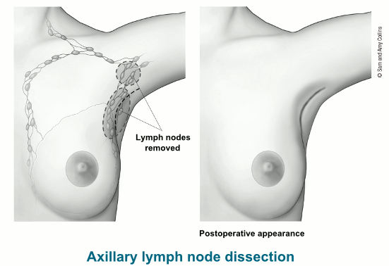 disección-de-nódulos-linfáticos-axilares